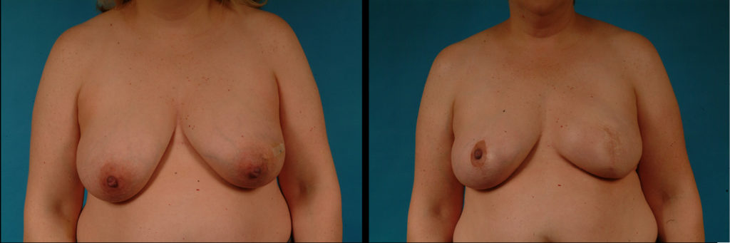 Unilateral Breast Reconstruction Before and After