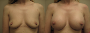 Dr. Leonardi Breast Augmentation
