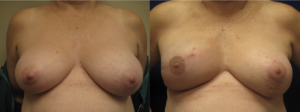 Dr Leonardi Breast Reconstruction