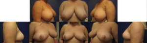 Dr. Leonardi Breast Reduction