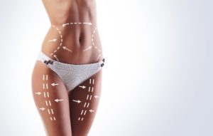 women getting liposuction