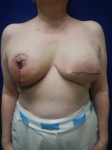 Pre-Pectoral Breast Reconstruction
