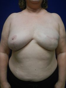 Pre-Pectoral Breast Reconstruction