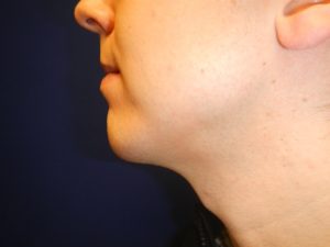 Dr. Tavin Chin and Neck Contouring