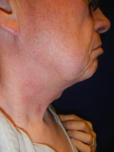 After Neck Contouring