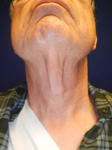 Before Neck Contouring