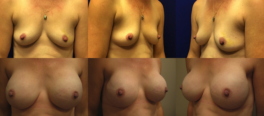 Dr Leonardi Breast Reconstruction