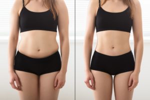 Everything You Need To Know About Abdominoplasty