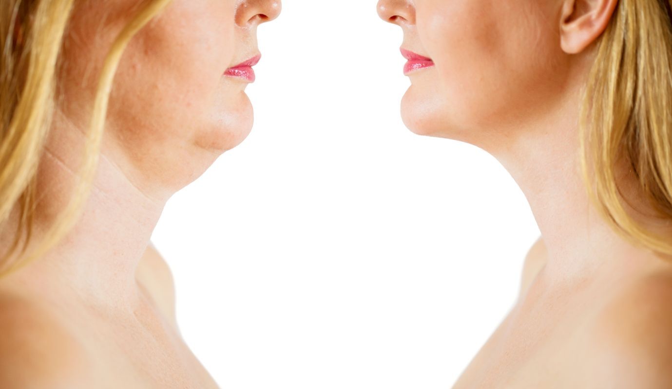 Eliminate Fat with Neck Contouring