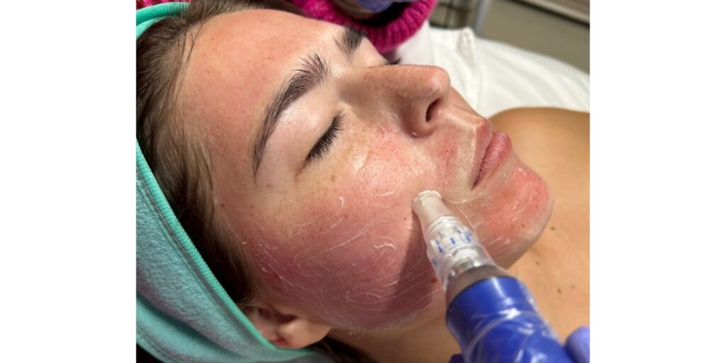 Revitalize Your Skin with SkinPen Microneedling 